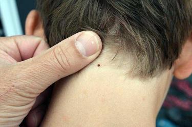 В Оренбуржье от укусов клещей пострадали уже 24 человека, в том числе 13 детей